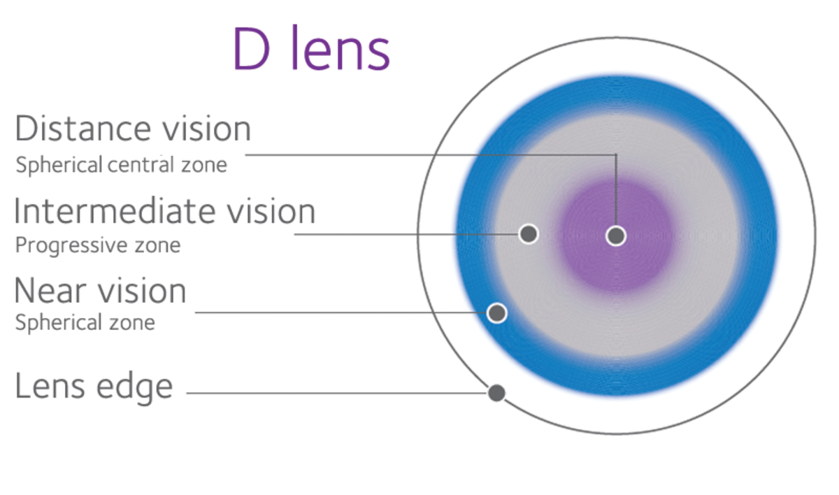 Myopia Control With Soft Multifocal Contact Lenses Benefits All ...